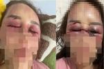 Người phụ nữ kể lại đêm kinh hoàng bị bạn trai đánh dập mũi gãy hàm-5