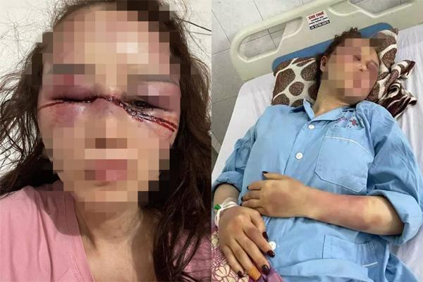 Cán bộ QLTT đã có vợ con, đánh bạn gái dập mũi gãy hàm vì quá yêu-4