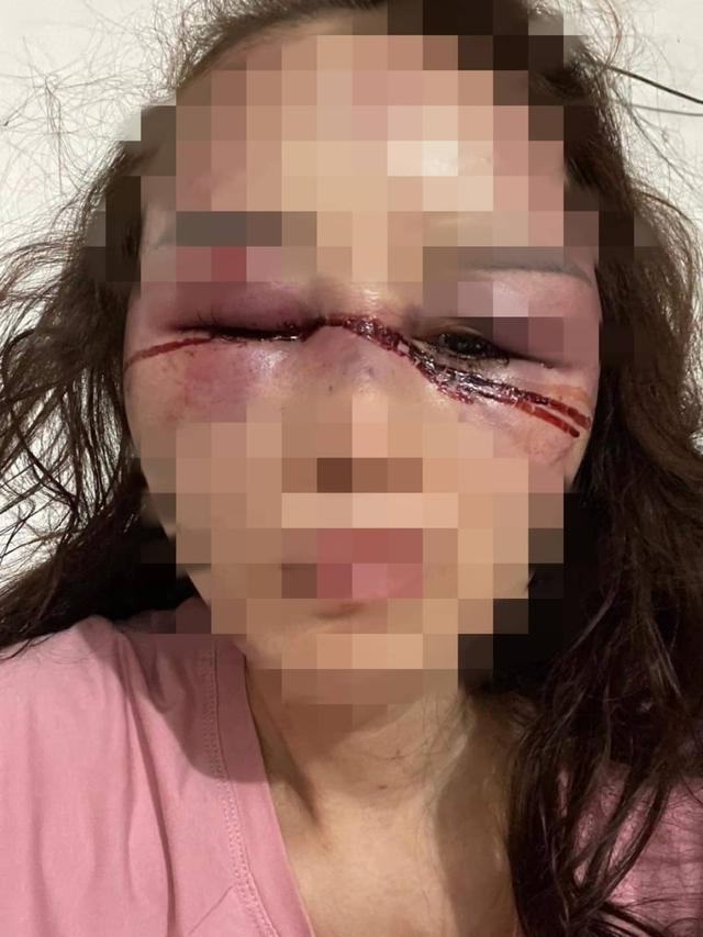 Người phụ nữ kể lại đêm kinh hoàng bị bạn trai đánh dập mũi gãy hàm-4
