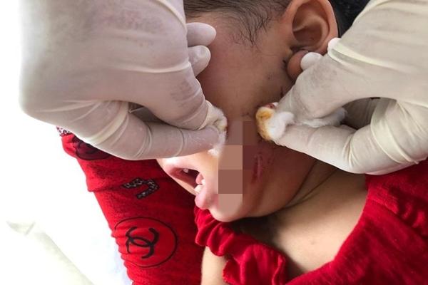 Chó dại tấn công cháu bé 19 tháng tuổi, gây thương tích nặng trên mặt-1