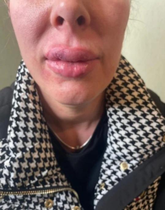 Hoãn đám cưới vì môi sưng vù do tiêm filler-1
