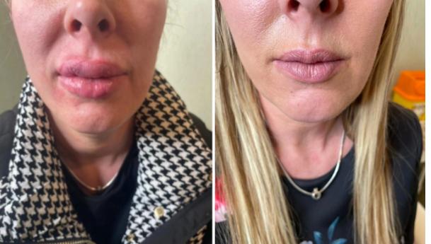 Hoãn đám cưới vì môi sưng vù do tiêm filler-2