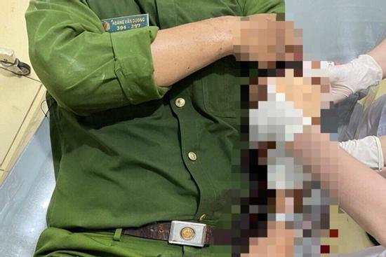 Trung úy công an bị đâm bằng xiên nướng thịt