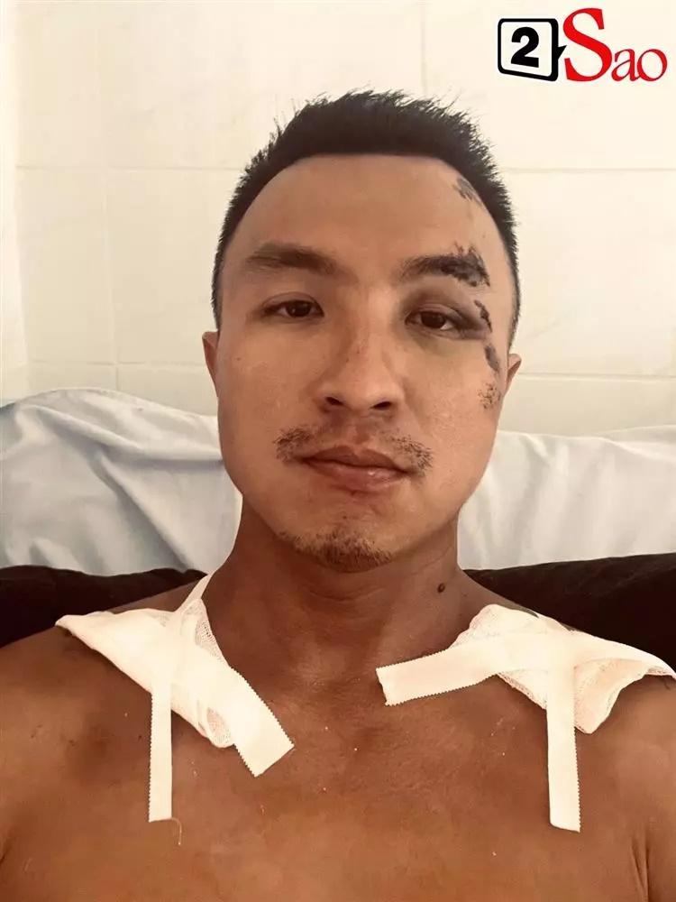 Tình hình nam MC sau tai nạn phải nối xương, lệch hàm-3