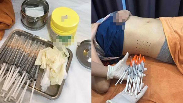 Tiêm tiêu mỡ lấy lại eo con kiến, cô gái trẻ nhập viện cầu cứu-1