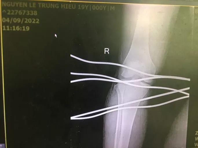 Kinh hoàng cảnh thanh niên bị 5 cây sắt đâm xuyên qua chân-3