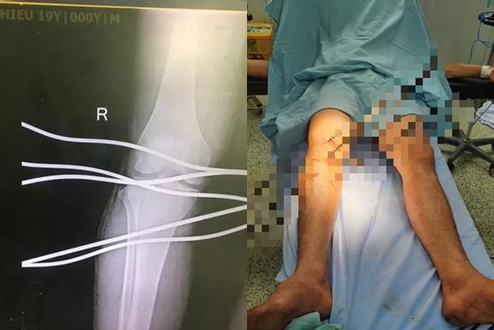 Kinh hoàng cảnh thanh niên bị 5 cây sắt đâm xuyên qua chân