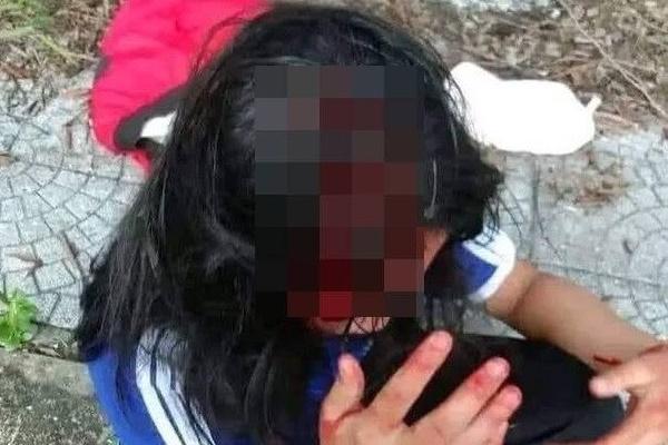 Học sinh lớp 1 bị cô giáo đánh bầm tím vai vì viết chậm-2