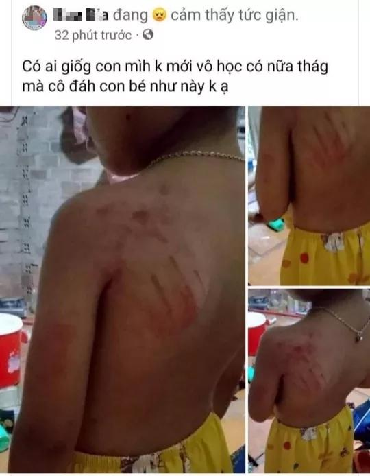 Học sinh lớp 1 bị cô giáo đánh bầm tím vai vì viết chậm-1