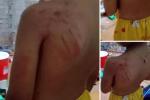 Trẻ mầm non ở Thái Bình bị cô giáo dùng gai bưởi đâm vào người-3
