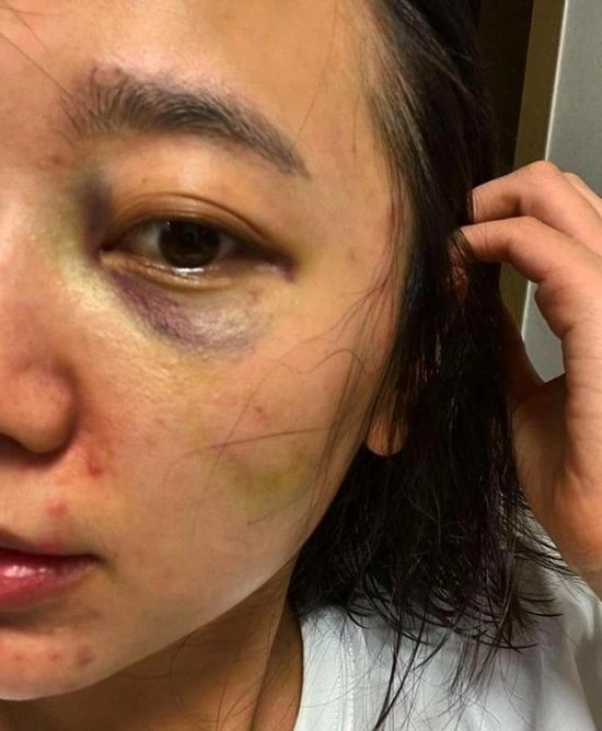 Ca sĩ Hàn Quốc tố chồng thường xuyên đánh đập-1