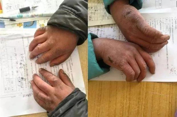 Cuộc sống cậu bé đóng băng hiện giờ thế nào?-4