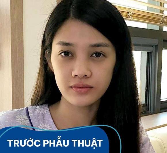Trình Mỹ Duyên lần đầu tiết lộ gương mặt có can thiệp thẩm mỹ-2