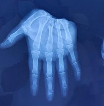 Nối thành công bàn tay của bé trai bị bạn chém đứt lìa-1