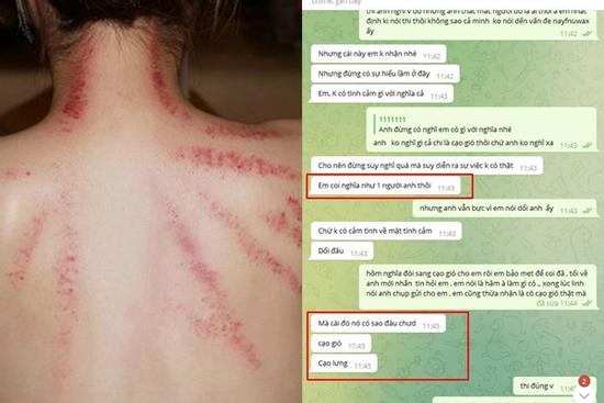 Bạn gái cởi áo cho anh kết nghĩa cạo gió, bạn trai hỏi câu hết hồn