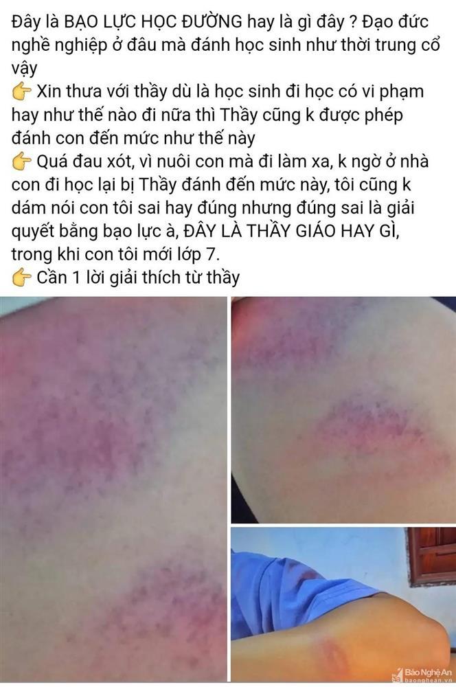Nữ sinh lớp 7 ở Nghệ An tố bị thầy giáo đánh bầm tím tay-1