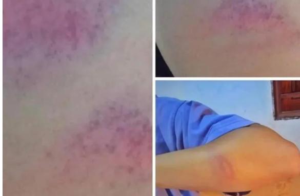 Thầy giáo cấp 2 ở Nghệ An bị tố đánh nữ sinh bầm tím tay-1