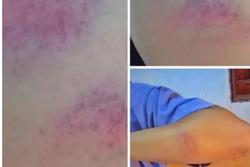 Thầy giáo cấp 2 ở Nghệ An bị tố đánh nữ sinh bầm tím tay