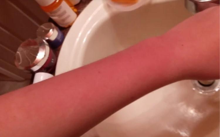 Kỳ lạ cô gái dị ứng nước, đụng vào là nổi mề đay-2