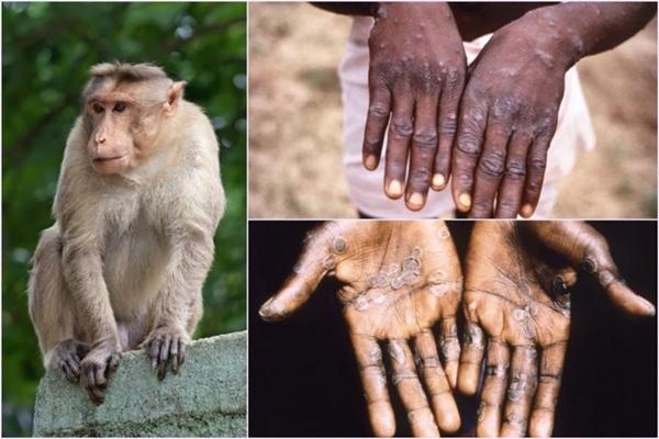 TP.HCM ghi nhận ca bệnh đậu mùa khỉ đầu tiên-1