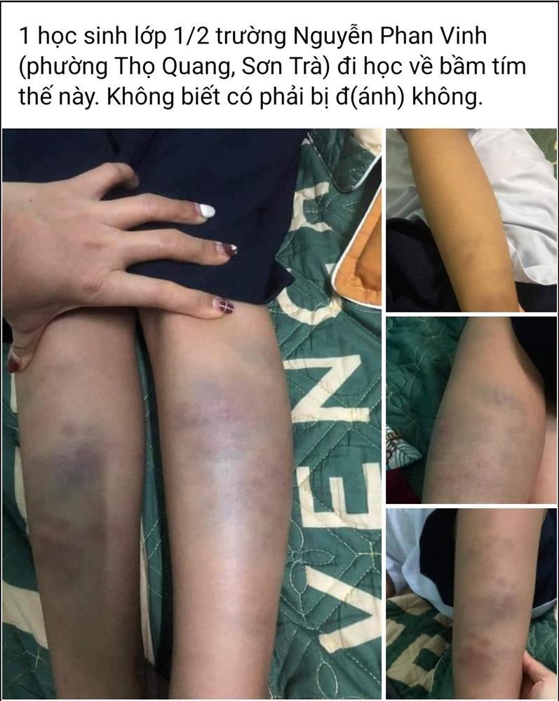 Xôn xao học sinh lớp 1 ở Đà Nẵng bị bầm tím tay chân sau buổi học-1