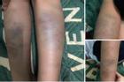 Xôn xao học sinh lớp 1 ở Đà Nẵng bị bầm tím tay chân sau buổi học