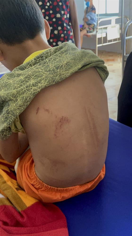 Bé trai 9 tuổi ở Quảng Bình bị bố đẻ dùng xăng và rơm đốt-1