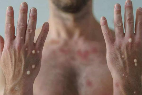 TP.HCM phát hiện ca đậu mùa khỉ thứ 2 về từ Dubai-2