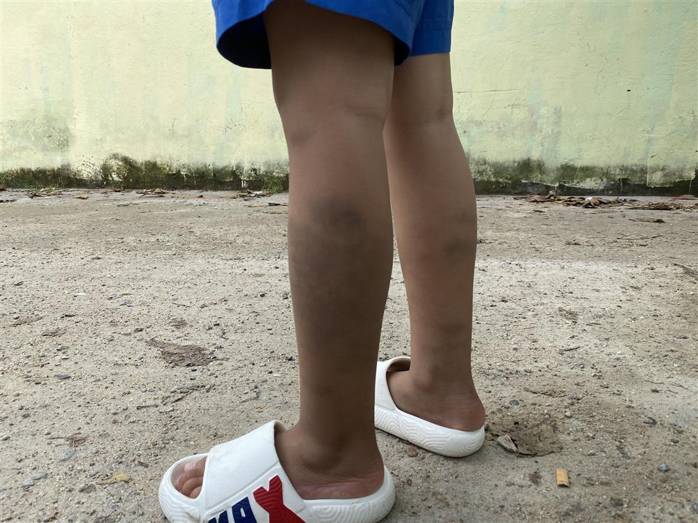 Vụ học sinh bầm tím chân tay: Phụ huynh không đồng ý kết luận bạn đánh-2