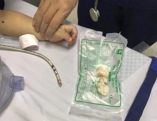 Cứu bé trai 22 tháng tuổi nguy kịch do hóc thạch rau câu-2