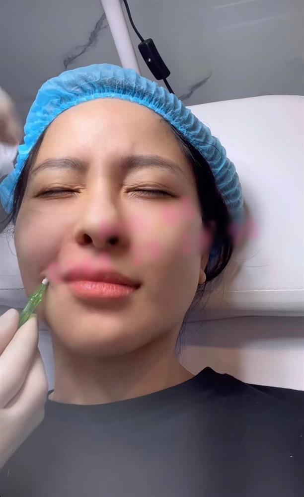 Trâm Anh gây hãi vì khoe cận cảnh tiêm mặt xóa rãnh cười-1