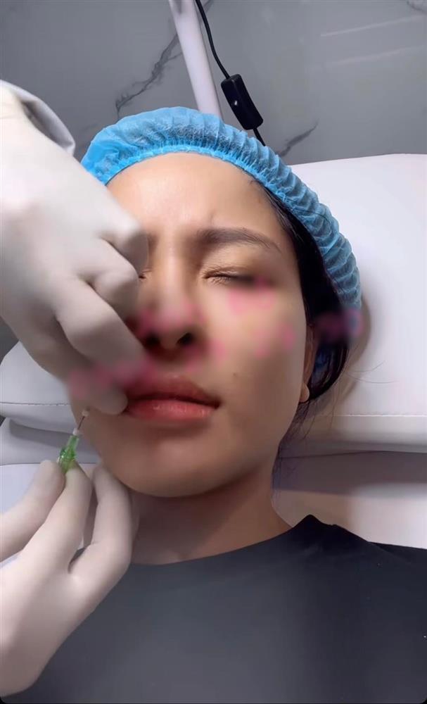 Trâm Anh gây hãi vì khoe cận cảnh tiêm mặt xóa rãnh cười-2