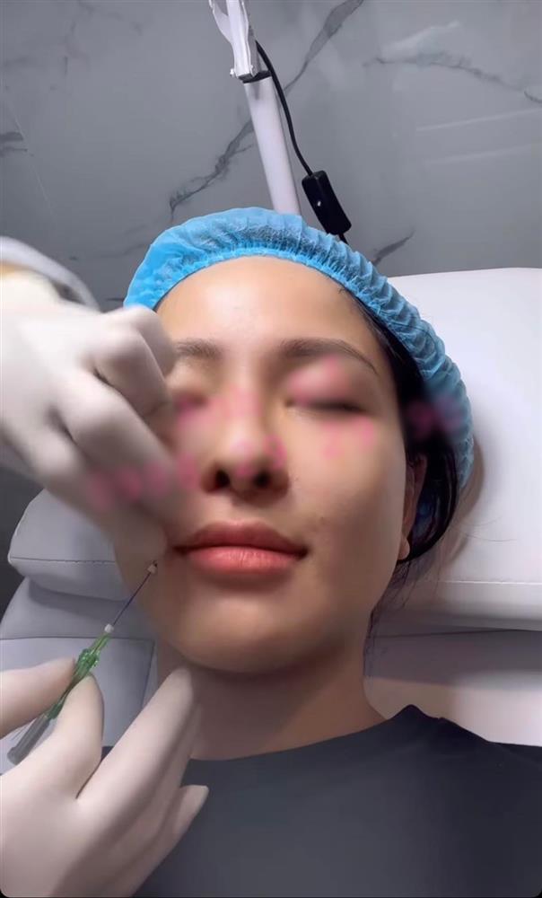 Trâm Anh gây hãi vì khoe cận cảnh tiêm mặt xóa rãnh cười-3