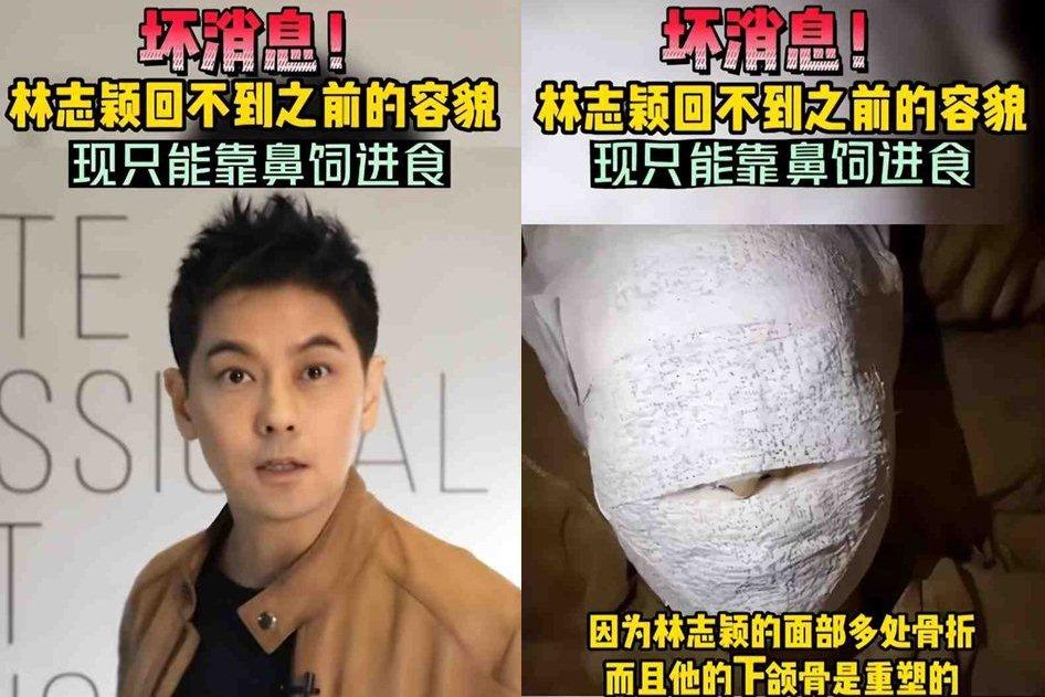 Thực hư Lâm Chí Dĩnh bó bột toàn mặt, phải ăn bằng mũi-2