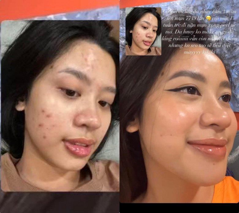 Ngã ngửa mặt mộc chi chít mụn hot girl nổi tiếng gốc Thanh Hóa-1