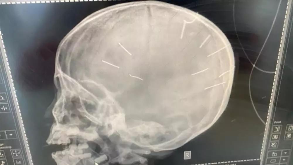 Tuyên án tử hình kẻ đóng đinh vào đầu bé gái 3 tuổi-4