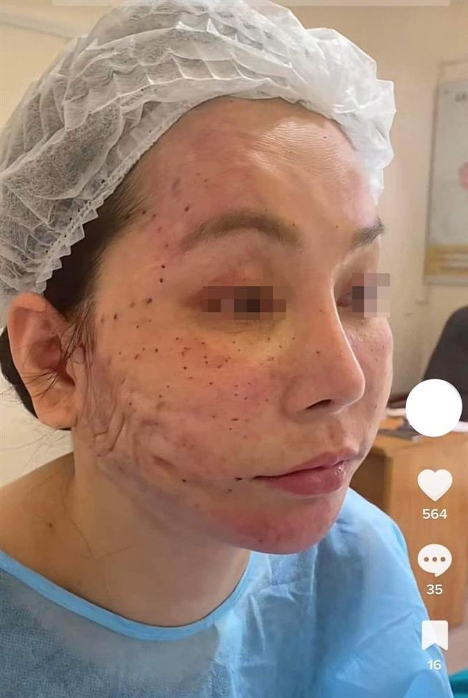 Hết hồn trước những ca biến chứng do căng chỉ da mặt-1