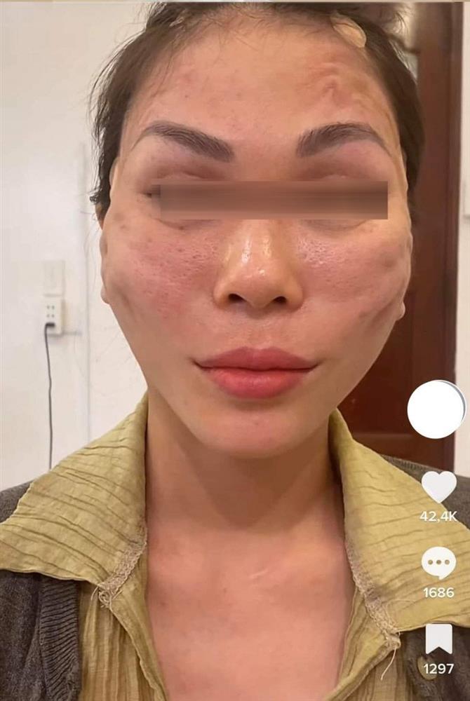 Hết hồn trước những ca biến chứng do căng chỉ da mặt-2