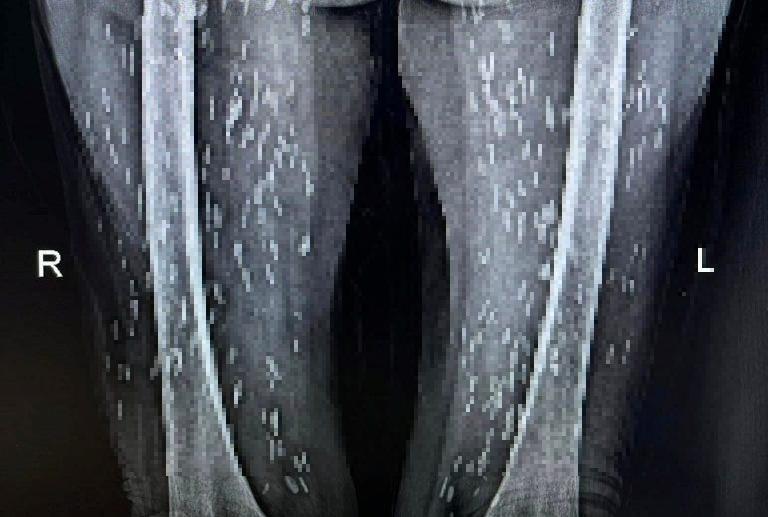 Rùng mình cụ bà 74 tuổi bị kén sán lan dày đặc khắp người-3