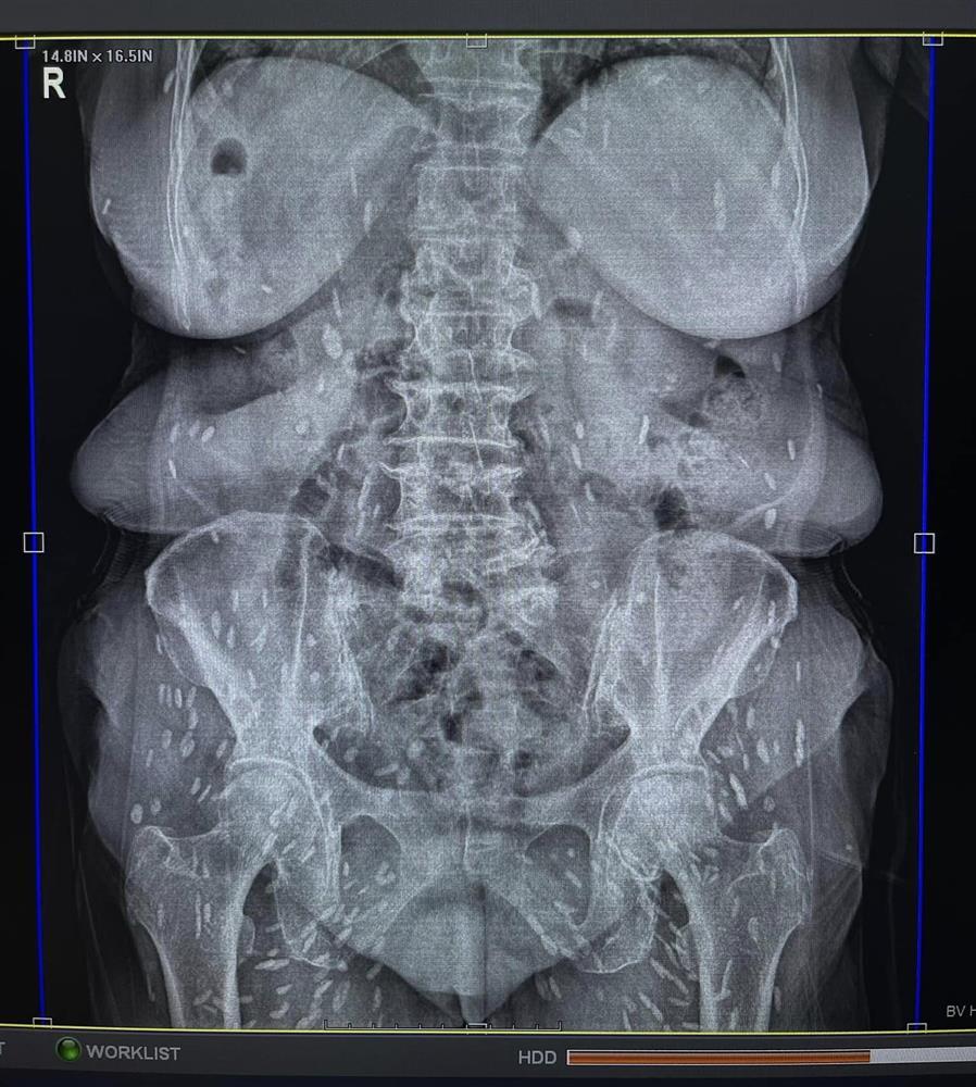 Rùng mình cụ bà 74 tuổi bị kén sán lan dày đặc khắp người-1