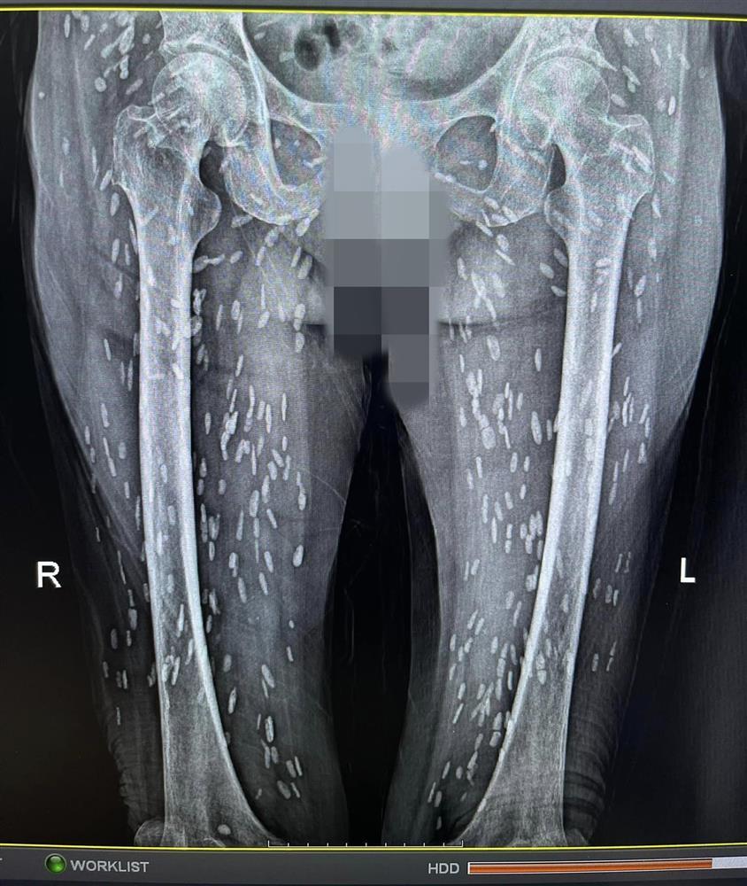 Rùng mình cụ bà 74 tuổi bị kén sán lan dày đặc khắp người-2