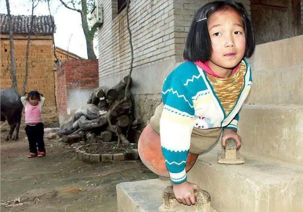 Cô bé bóng rổ bị cắt bỏ toàn bộ phần thân dưới bây giờ ra sao?-1