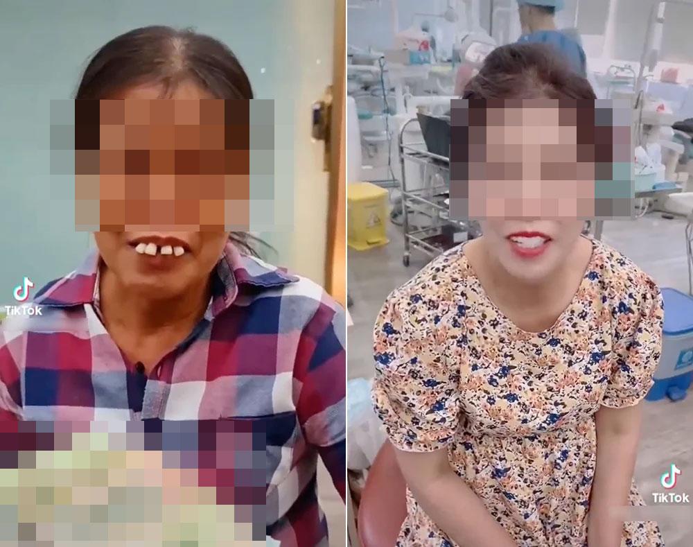 Người phụ nữ mang 10 triệu làm 4 chiếc răng vâu, thành quả ngất lịm-3