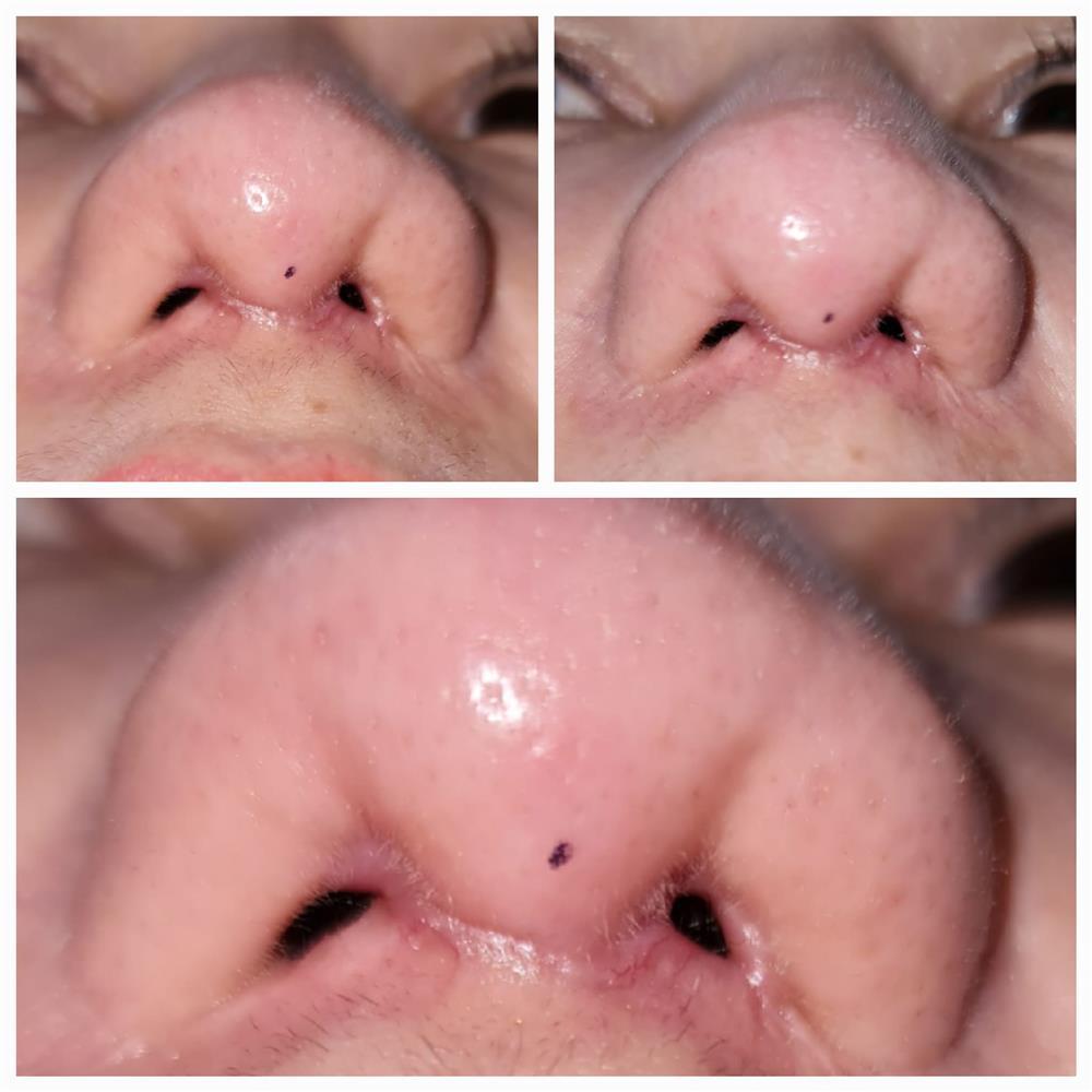 Khóc ròng vì nâng mũi tại spa-1