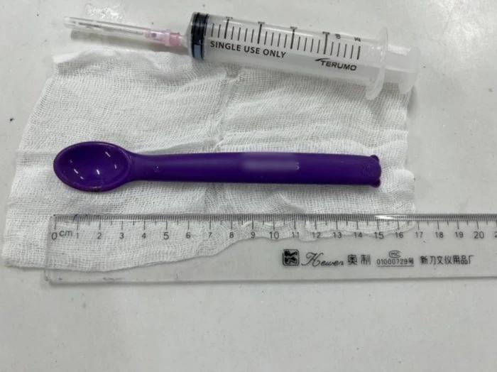 Say rượu, cô gái ở Vĩnh Phúc nuốt luôn chiếc thìa dài 15cm-1