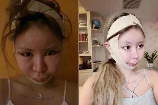 Người mẹ Nhật Bản ép con gái 9 tuổi cắt mí, làm mũi, nâng ngực-1