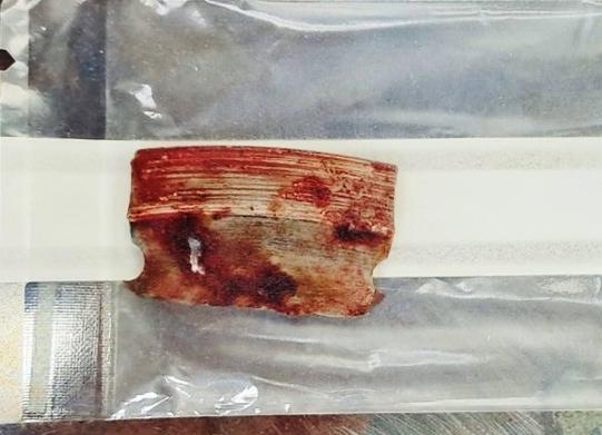 Lưỡi cưa cắt đá văng trúng, cắm sâu vào bụng người đàn ông-1