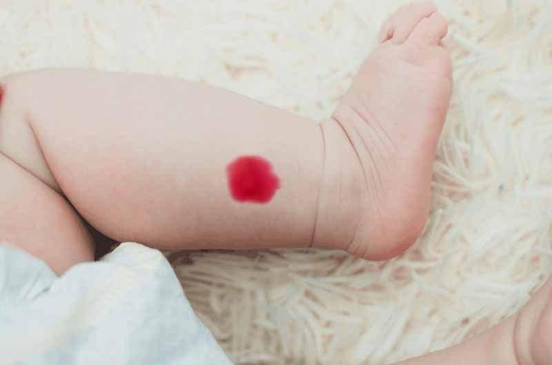 Vết bớt tiền kiếp nhưng dự đoán tương lai, vết bớt ở đâu đại vận khí?-2