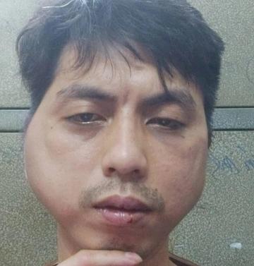 Khởi tố vụ nhân viên bị chủ quán lẩu đánh biến dạng mặt-1