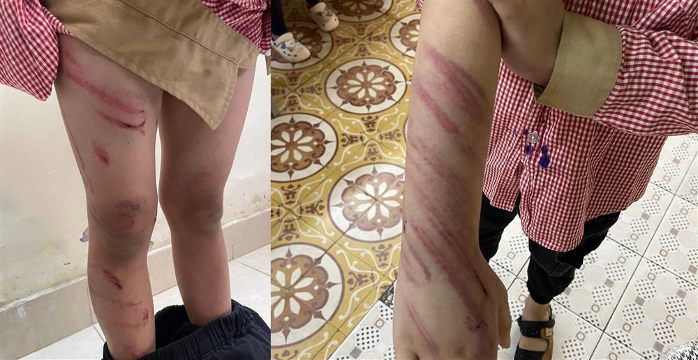 Bé trai 8 tuổi bị bố dượng đánh chỗ tứa máu, chỗ tím bầm-2